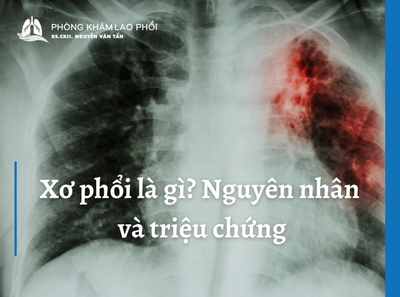 Xơ phổi là gì? Nguyên nhân, triệu chứng và cách điều trị